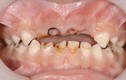 Đây chính là sai lầm trầm trọng khiến trẻ sâu hỏng cả hàm răng